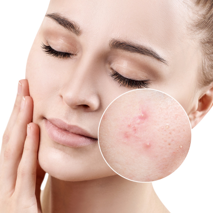 woman-before-with-acne-after-mineral-makeup-coverage.jpg